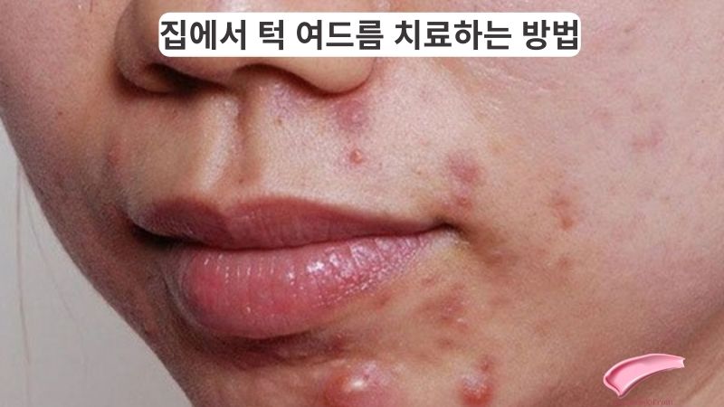 집에서 턱 여드름 치료하는 방법