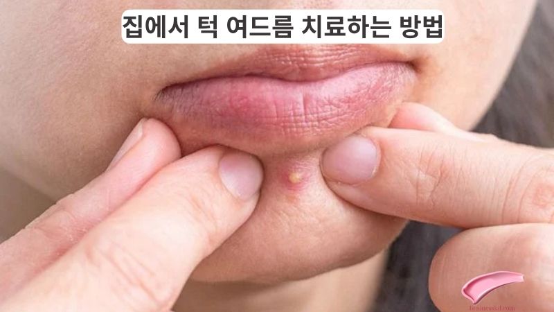 집에서 턱 여드름 치료하는 방법