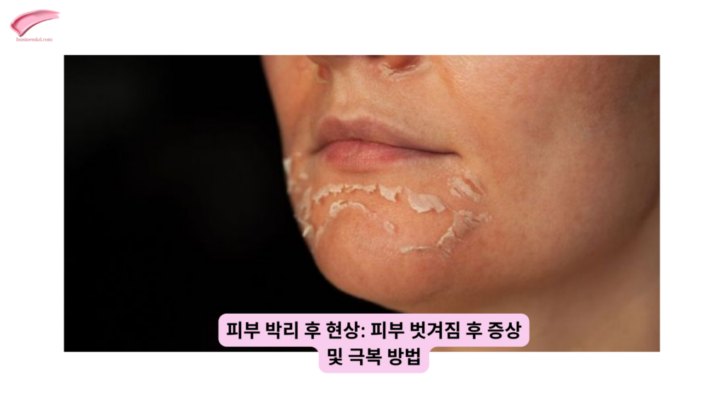 레이저 시술 후 피부 재생 크림