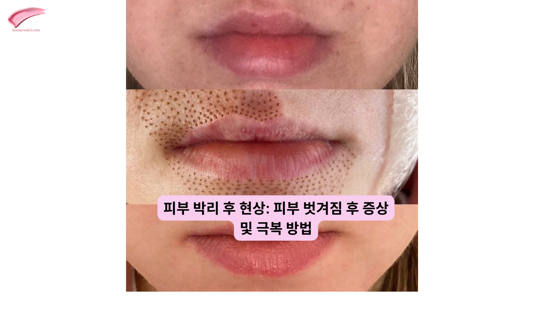 레이저 시술 후 피부 재생 크림